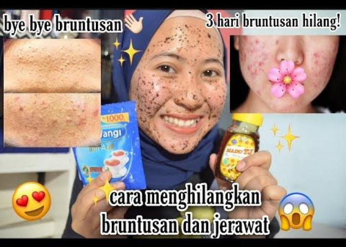 Cara Alami Hilangkan Jerawat dalam Semalam: Solusi Kilat untuk Kulit Lebih Bercahaya